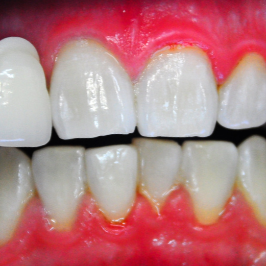 enWHITE Teeth Whitening Best Affordable Teeth Whitening Kit Australia